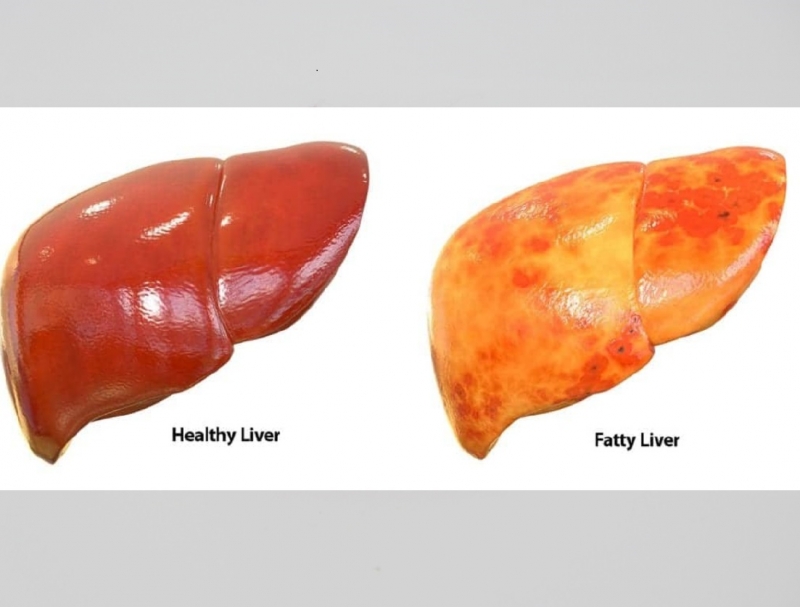 Fucoidan: preventive effect on non -alcoholic fatty liver disease