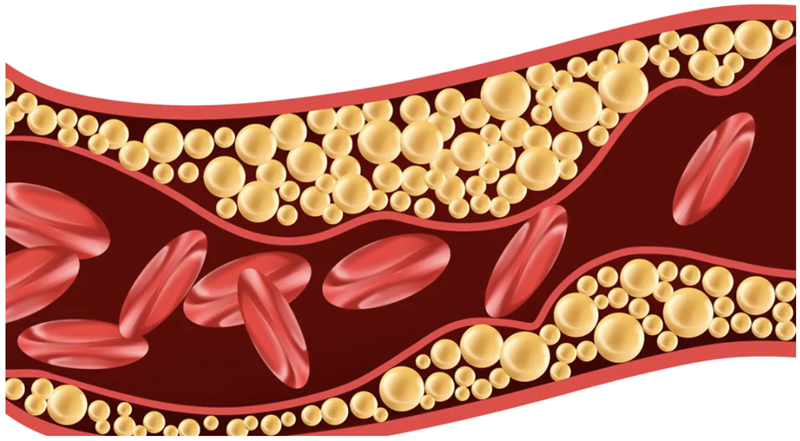 Anti-inflammatory potential of fucoidan for atherosclerosis
