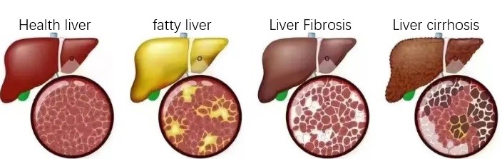 3 stages of fatty liver.jpg